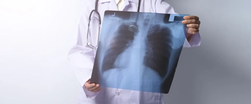 2 Misinformed “Popcorn Lung” News Articles Attack Vaping in the UK